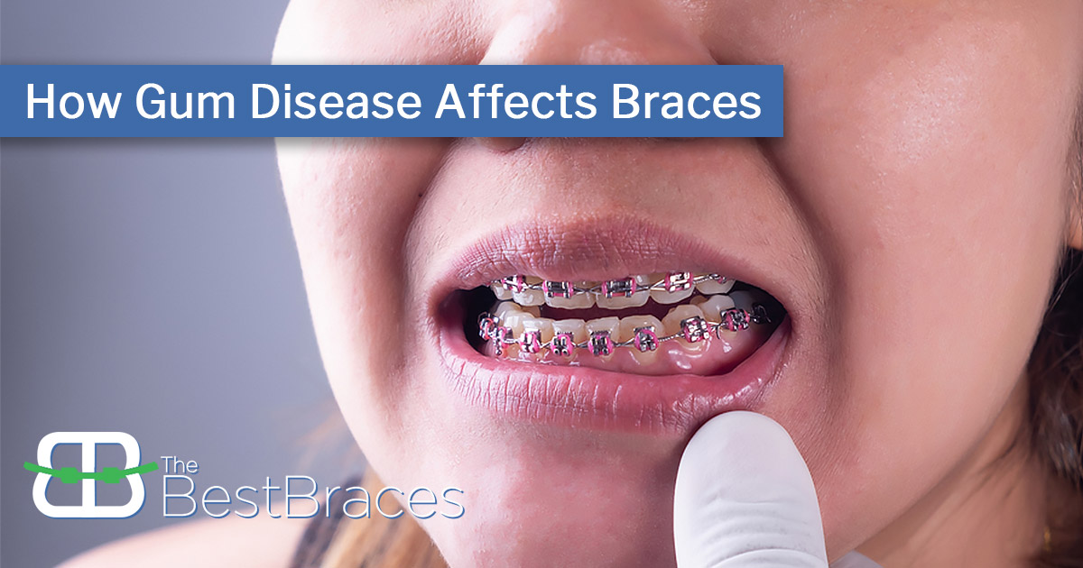 How Gum Disease Affects Braces The Best Braces Orthodontists In Southfield Mi 