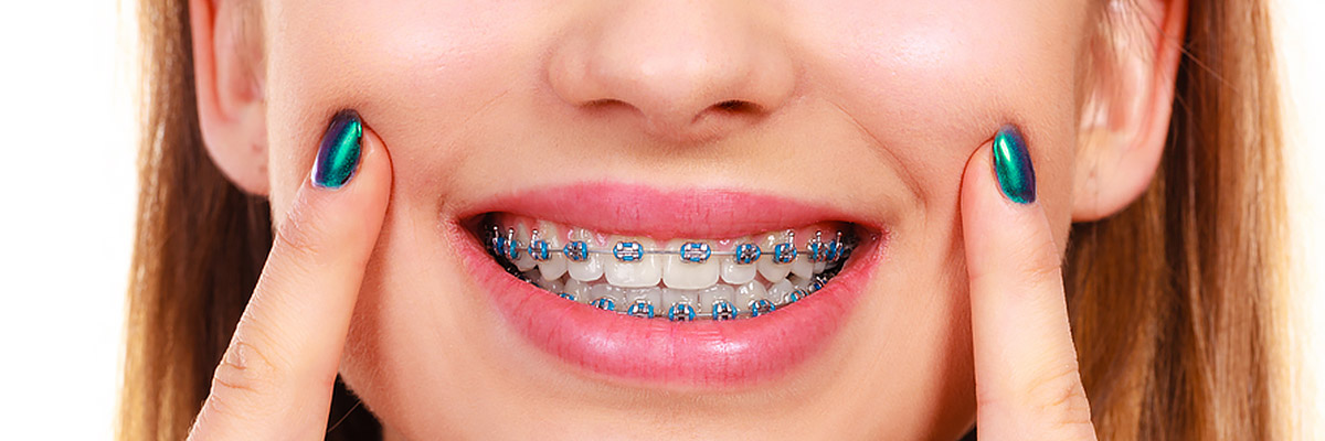 Best Priced Invisalign Clear Aligners, Troy, MI