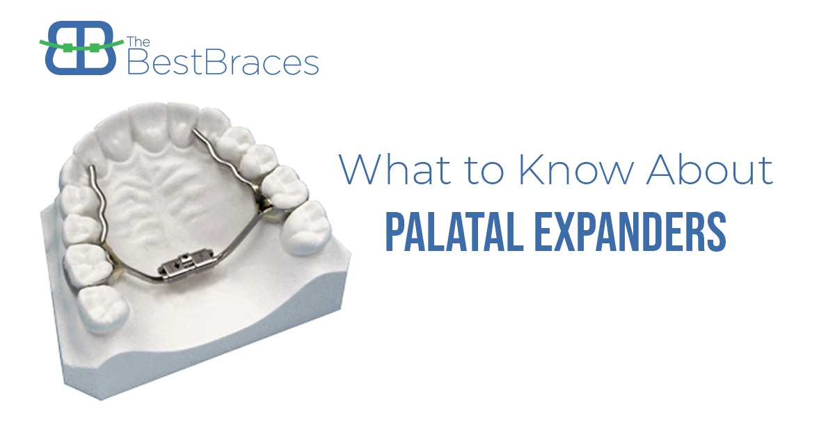 What is a Palatal Expander?